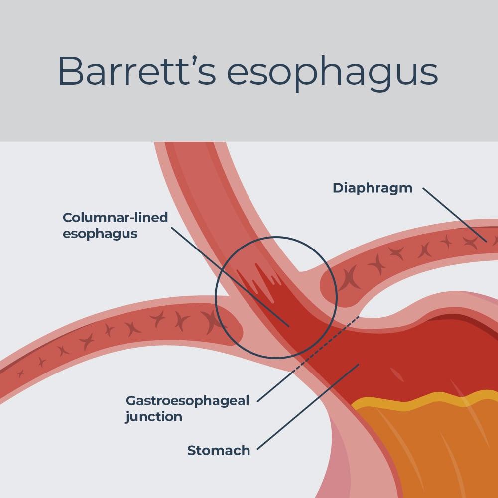 tc-barretts-esophagus-illustration_r3 tc-barretts-esophagus-illustration_r3