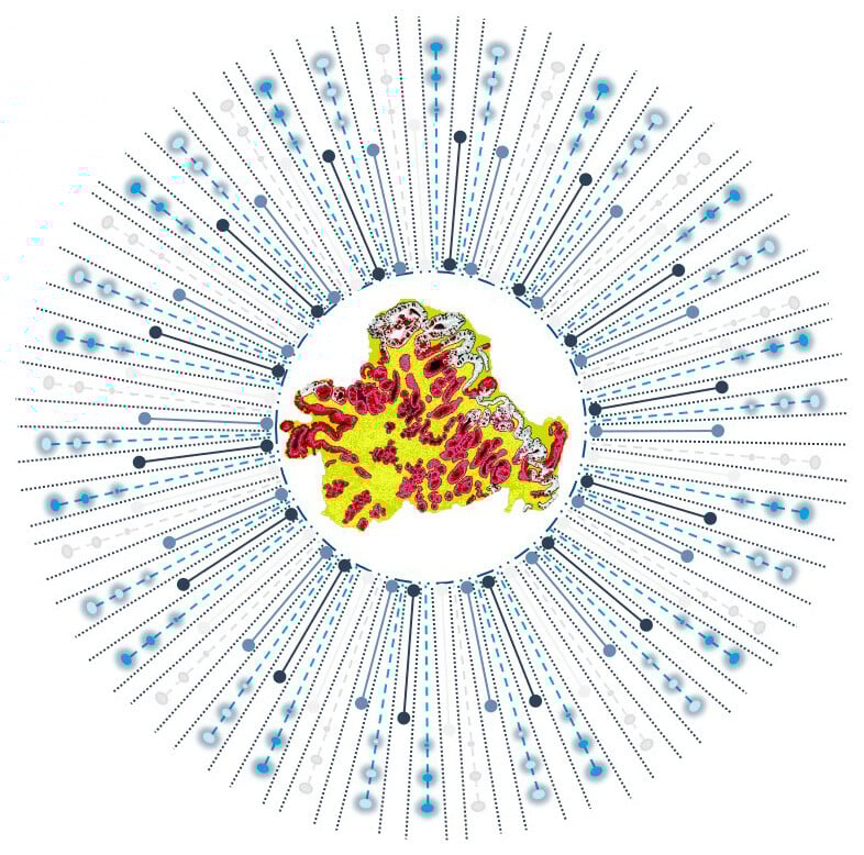 An illustration of a pinch biopsy and how TissueCypher can extract millions of spatialomic features.